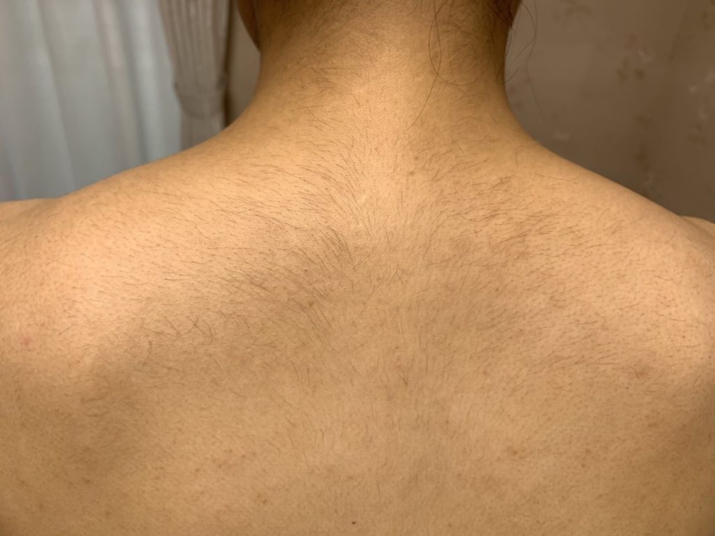 医療レーザー脱毛で背中が硬毛化多毛化してしまったお客さま！電気脱毛でお悩みサヨナラ！