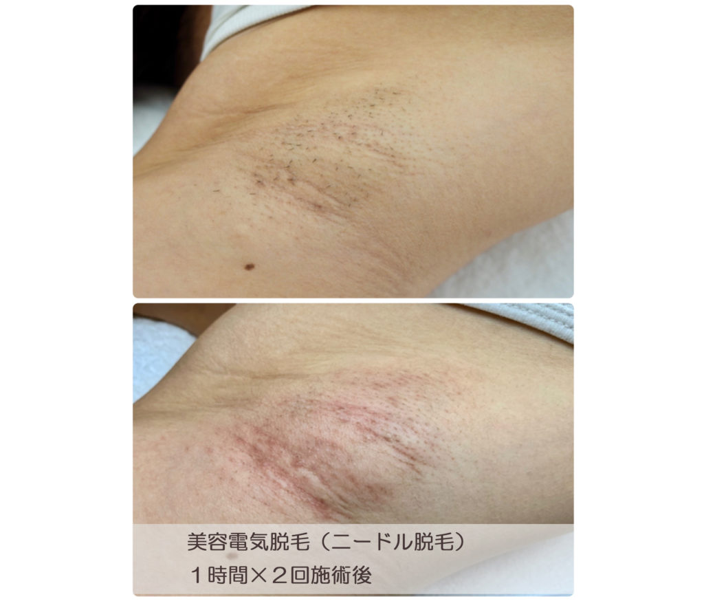 医療レーザーやエステの光脱毛じゃなく、脇毛の処理を最初から電気脱毛をチョイスされるお客さま