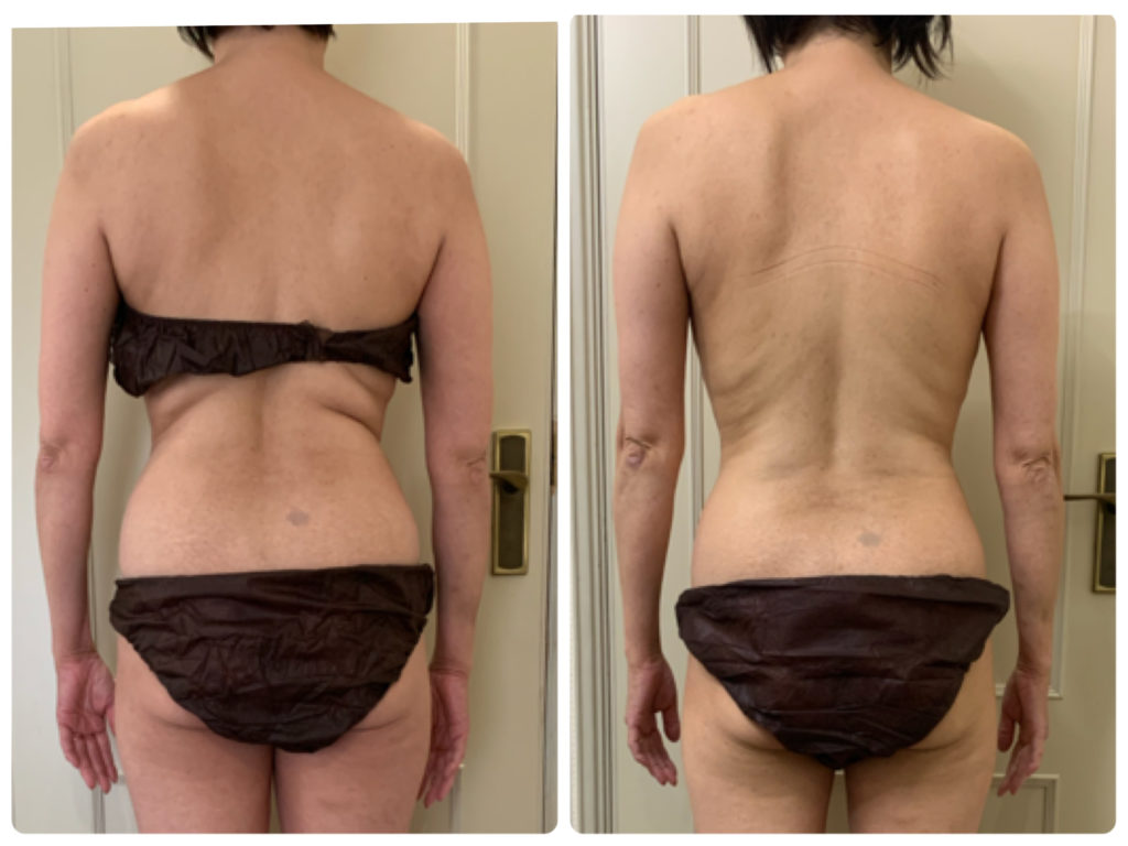 アトピー、アレルギーなどの体質改善に痩身がついてくるインディバボディ