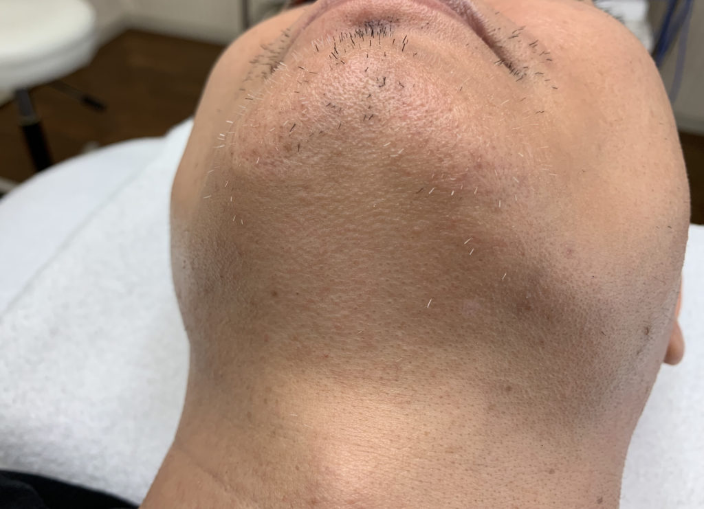 ヒゲの白髪脱毛の処理は美容電気脱毛（ニードル脱毛）しかムリです♡