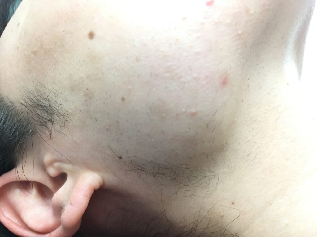 ５〜６０代女性のお口周りやアゴ先の太い毛は美容電気脱毛でサヨナラしましょう！