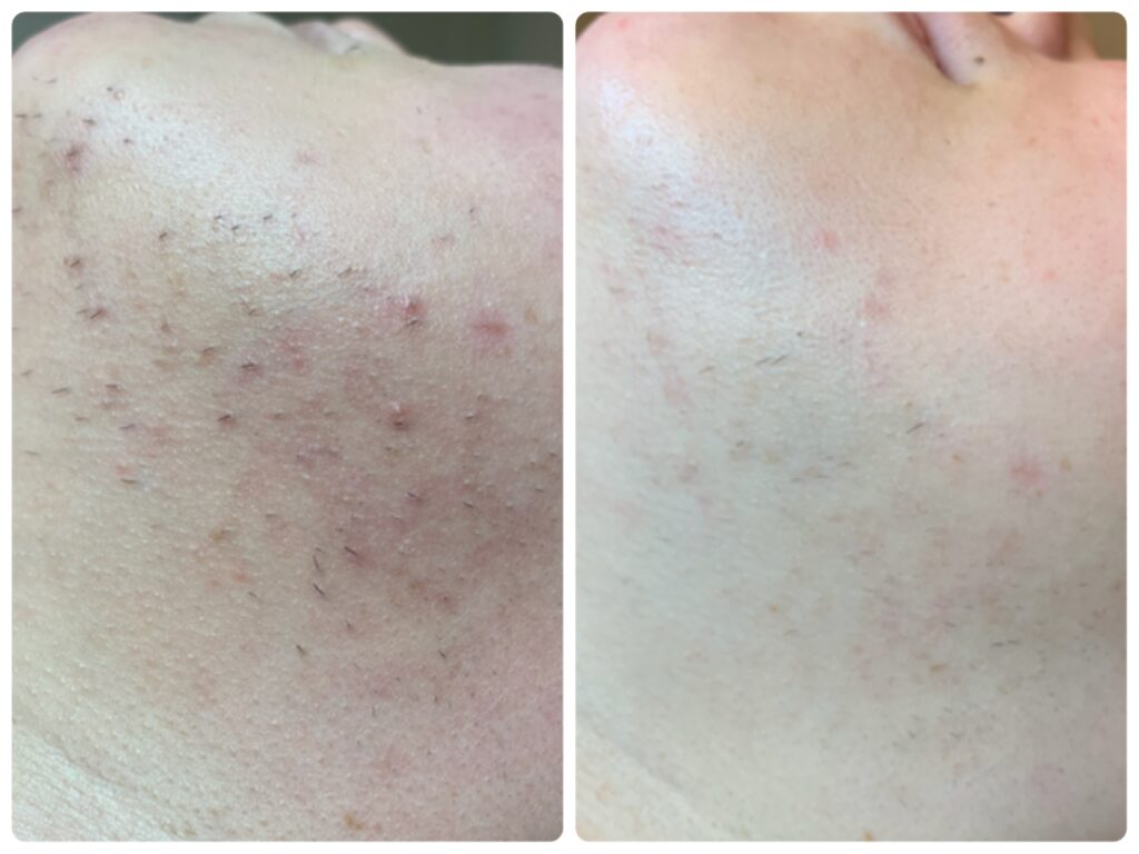 30代女性　レーザー脱毛によるアゴの毛の硬毛化にサヨナラ