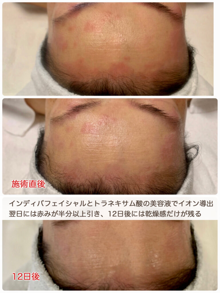 アトピー体質の方はインディバでラクになりましょう！＿ビューラー大谷ができる施術とご指導