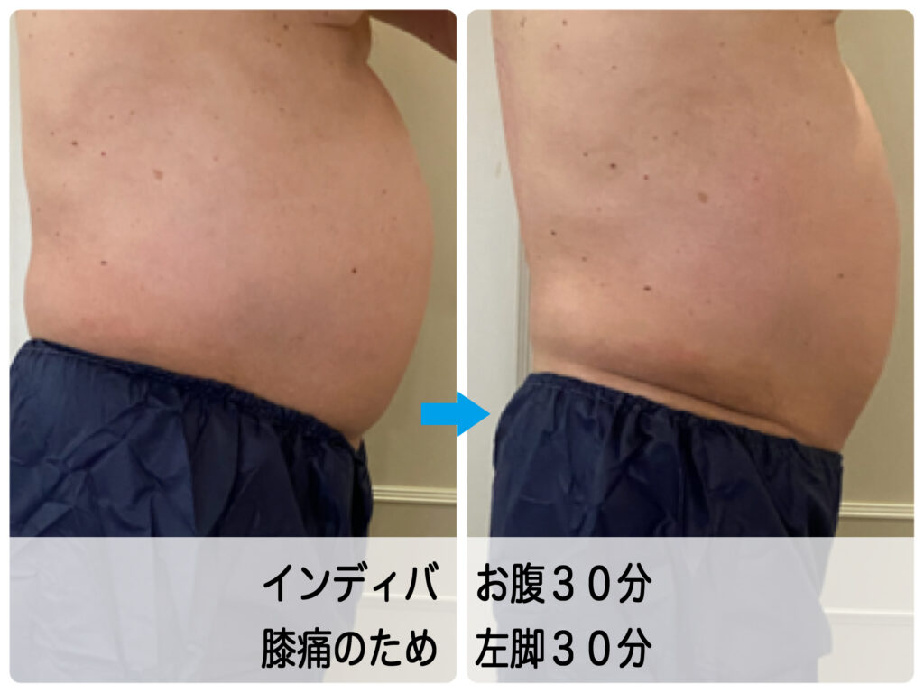 膝痛の男性のお客さま＿高血圧と高脂血症の既往症＿インディバケア