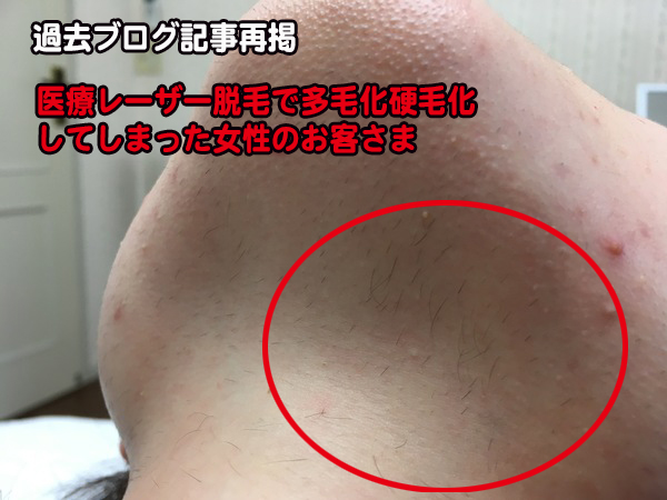 レーザーや光脱毛で「硬毛化、多毛化」してる方は迷わず美容電気脱毛（針脱毛）へ！