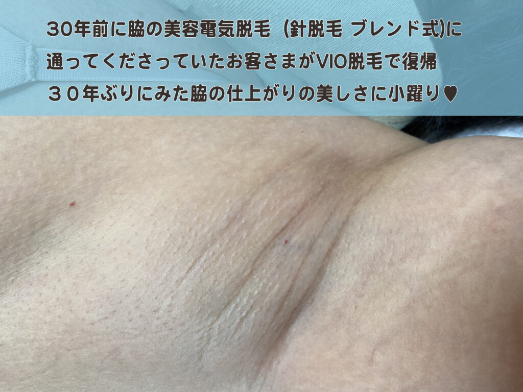 30年ぶりの美容電気脱毛のお客さま  　脇を完璧に仕上げた成功体験から今度はVIOへ