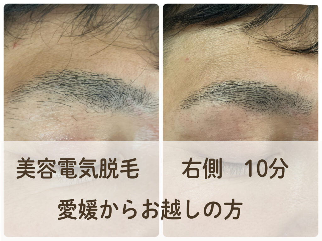 美容電気脱毛で眉毛のデザインやレーザーの取り残しの施術＿愛媛からお越しの方＿＿肌質体質改善エステ・ビューラー大谷
